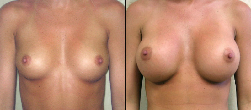 Breast Augmention Before and After 1